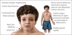 Physique caractéristique chez l'enfant  atteint du syndrome de Noonan