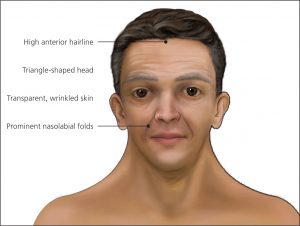 Visage caractéristique chez l'adulte atteint du syndrome de Noonan