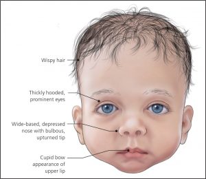 Visage caractéristique chez l'enfant  atteint du syndrome de Noonan